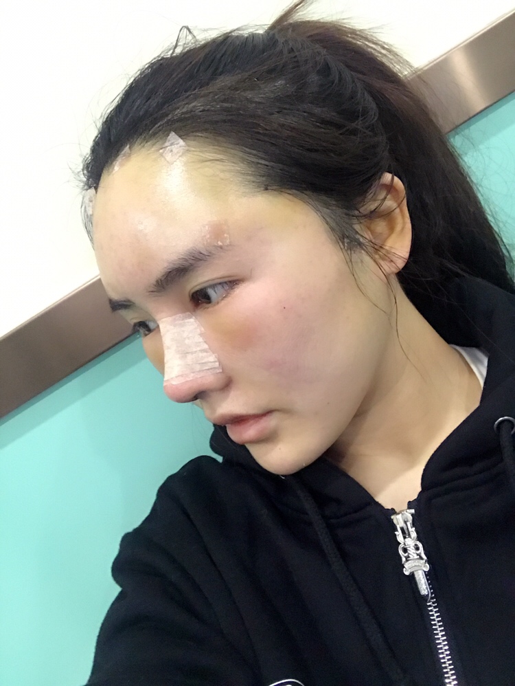 膨體隆鼻手術(shù)過程