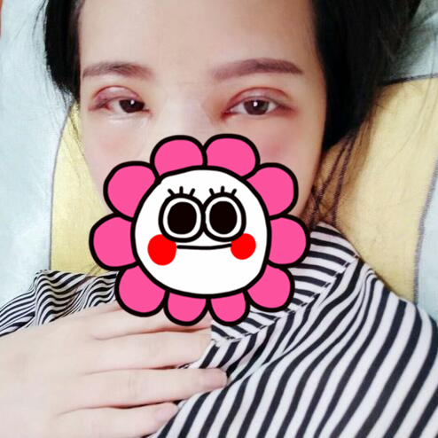 剛做完切開雙眼皮時(shí)的樣子