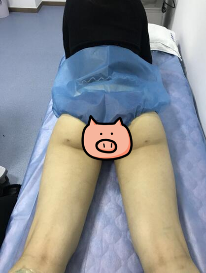 鄭州至美整形專家劉永生做大腿吸脂怎么樣？劉永生做大腿吸脂案例效果