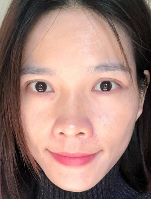 北京藝星整形專家廖苑利做光子嫩膚怎么樣？廖苑利光子嫩膚案例效果展示