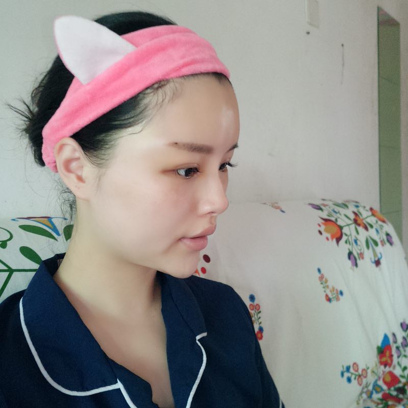 自體脂肪填充臉部案例效果圖