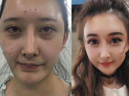 面部脂肪填充，整個人都發(fā)生了很大變化。