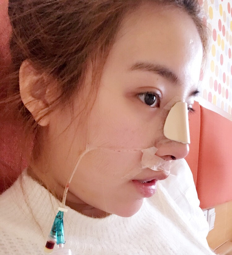 剛做完鼻部修復(fù)
