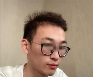 臉上的黑色素沉積使整個(gè)人失去光澤