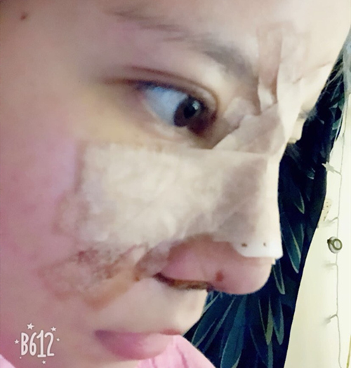 嘉興曙光美容醫(yī)院整形專家王良發(fā)做假體隆鼻怎么樣？王良發(fā)假體隆鼻案例