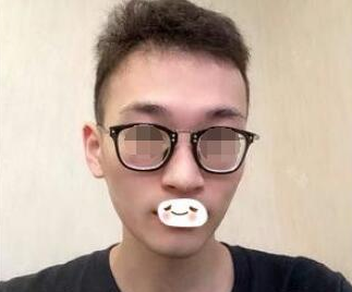 做完彩光嫩膚后的效果