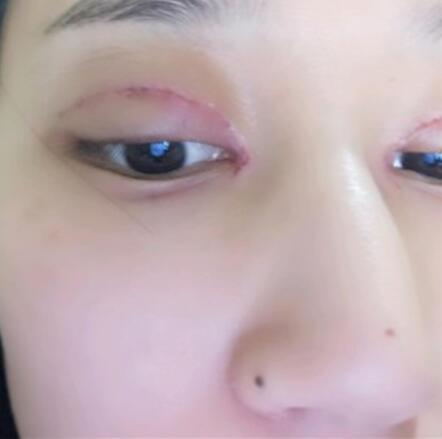 北京葉子整形美容醫(yī)院做焊接雙眼皮效果怎么樣？北京葉子整形焊接雙眼皮案例展示