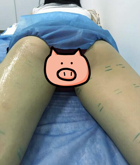 準(zhǔn)備進(jìn)行大腿吸脂手術(shù)