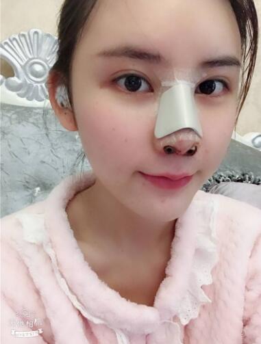 做完肋軟骨隆鼻恢復中