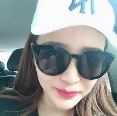 蔣正華醫(yī)生玻尿酸豐唇效果