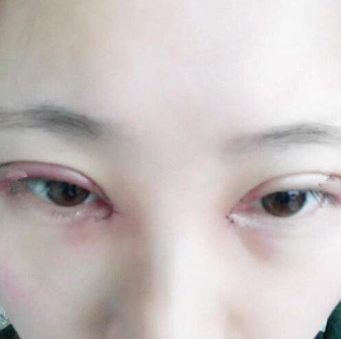 眼綜合整形手術(shù)后