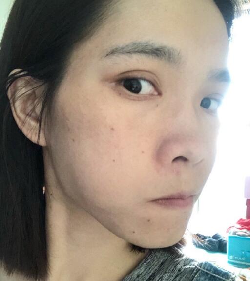 廖苑利光子嫩膚案例效果展示：