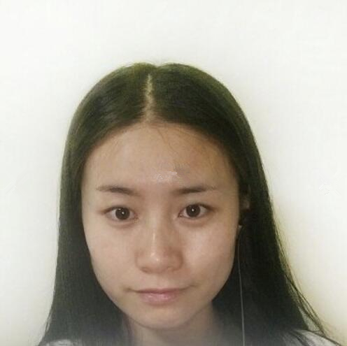 長(zhǎng)沙愛(ài)思特整形醫(yī)生楊千里雙眼皮修復(fù)案例效果對(duì)比圖