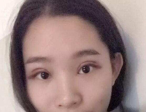 鄭州蕾娜斯彭沖醫(yī)生做微創(chuàng)雙眼皮案例效果對比圖