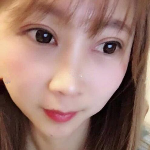淄博美聯(lián)臣醫(yī)療美容醫(yī)院做切開雙眼皮怎么樣？切開雙眼皮案例分享