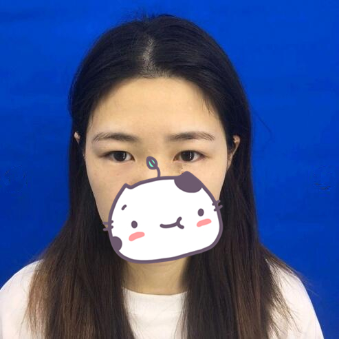 西昌玥美整形專家湯穎峰做雙眼皮怎么樣？湯穎峰雙眼皮案例賞析