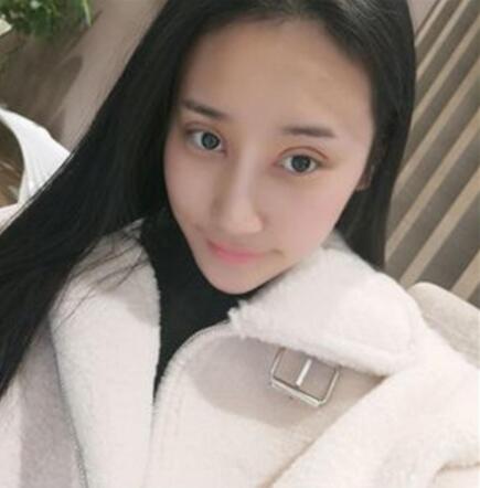北京葉子整形焊接雙眼皮案例展示