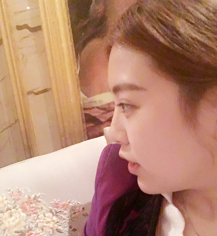黑龍江藝星醫(yī)生巫文云做鼻部修復(fù)怎么樣，巫文云玻鼻部修復(fù)案例分享