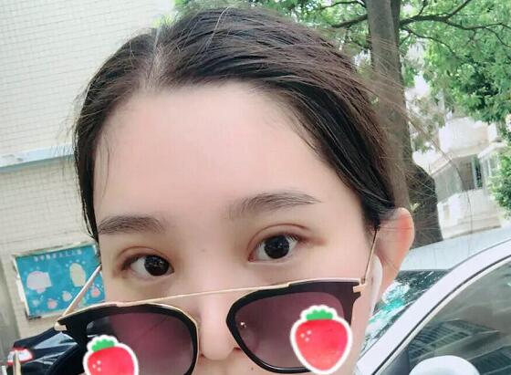 鄭州蕾娜斯彭沖醫(yī)生做微創(chuàng)雙眼皮效果怎么樣？微創(chuàng)雙眼皮案例效果展示