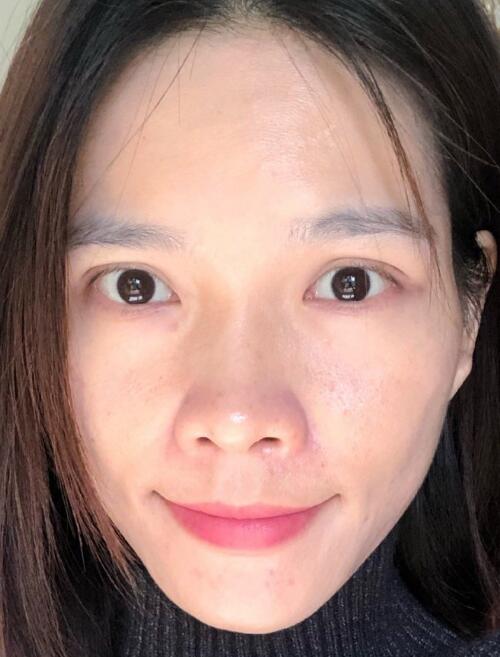 廖苑利光子嫩膚案例效果展示：