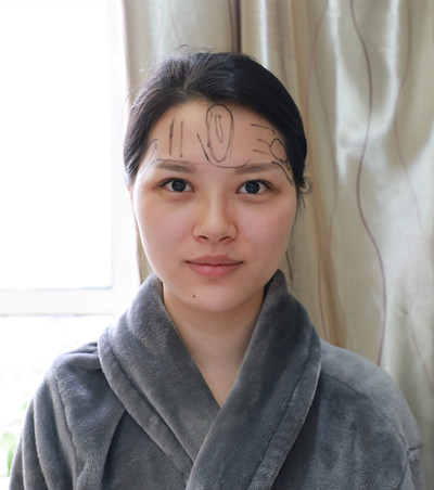 昆明醫(yī)科大學(xué)第一附屬醫(yī)院整形外科做臉部脂肪填充效果怎么樣？