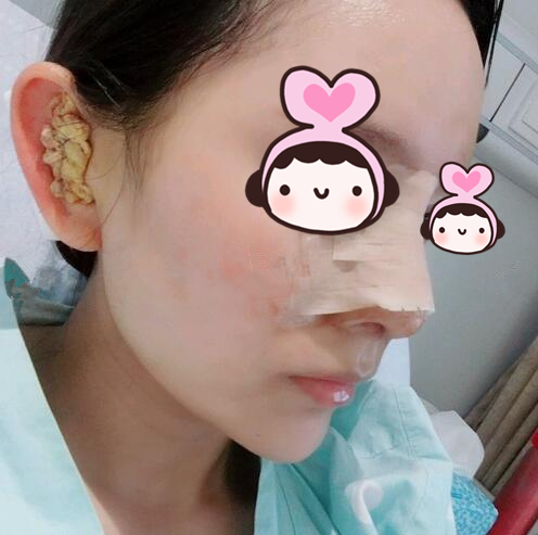 廈門海峽整形專家王翼耕做隆鼻的心得體會(huì)，王翼耕做隆鼻效果怎么樣？