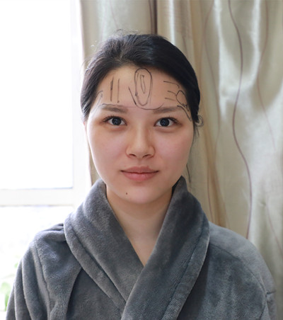 自體脂肪填充臉部案例效果圖