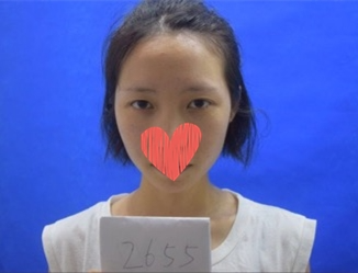 北京美萊整形專家杜園園開外眼角怎么樣？杜園園開外眼角案例效果對比圖