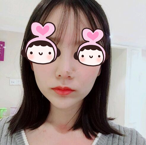 廈門海峽整形專家王翼耕做隆鼻的心得體會(huì)，王翼耕做隆鼻效果怎么樣？