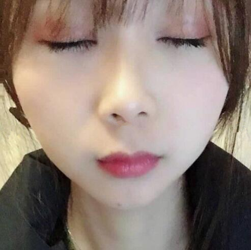 眼綜合整形手術(shù)半個月。