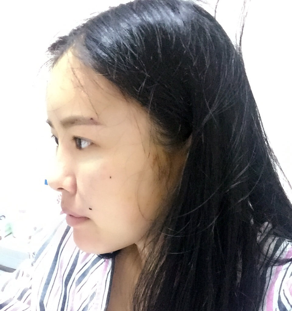 手術當天