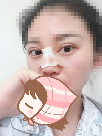 術(shù)后60天效果。