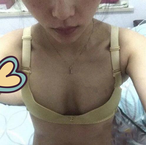 廣州駐顏光醫(yī)療美容診所整形專家劉培做復(fù)合隆胸技術(shù)怎么樣？附案例