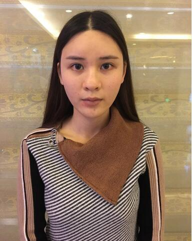 北京藝星整形專家郭峰做假體隆鼻修復(fù)怎么樣？郭峰假體隆鼻修復(fù)案例