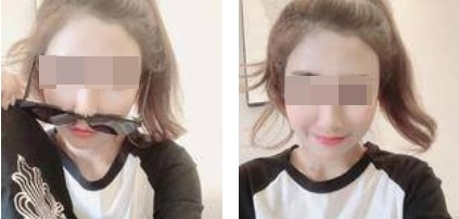 昆明麗都整形醫(yī)生孟春麗做面部自體脂肪填充效果怎么樣？