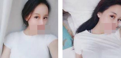 寧波美仁整形美容醫(yī)院李英大醫(yī)生做切開雙眼皮效果怎么樣？