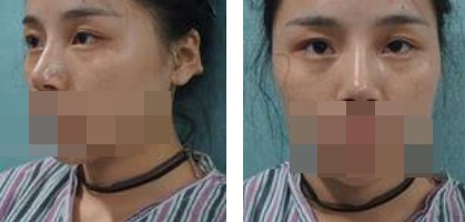 寧波美仁整形美容醫(yī)院李英大醫(yī)生做切開雙眼皮效果怎么樣？