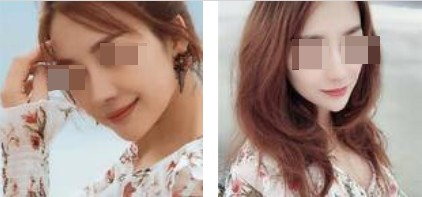 上海攸維醫(yī)療美容診所整形醫(yī)生李靜做膨體隆鼻效果怎么樣？附案例展示