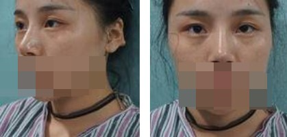 寧波美仁整形美容醫(yī)院李英大醫(yī)生做切開雙眼皮效果怎么樣？