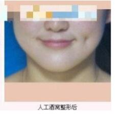 德州市第二人民醫(yī)院燒傷美容整形科張波濤醫(yī)生做酒窩成形術(shù)怎么樣？