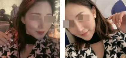 蘭州美月整形美容醫(yī)院文輝才醫(yī)生做鼻綜合整形效果怎么樣？附鼻綜合案例
