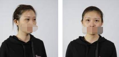 沒有了眼袋困擾，身體和心態(tài)都年輕了十歲