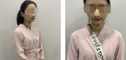 美麗自信的生活從自體軟骨隆鼻開(kāi)始