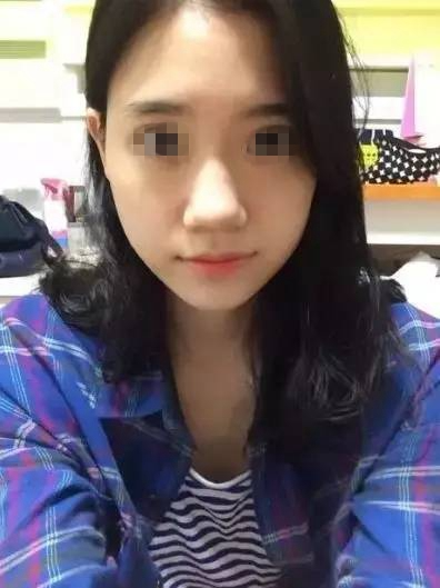 做完膨體隆鼻，鼻子變“挺”了