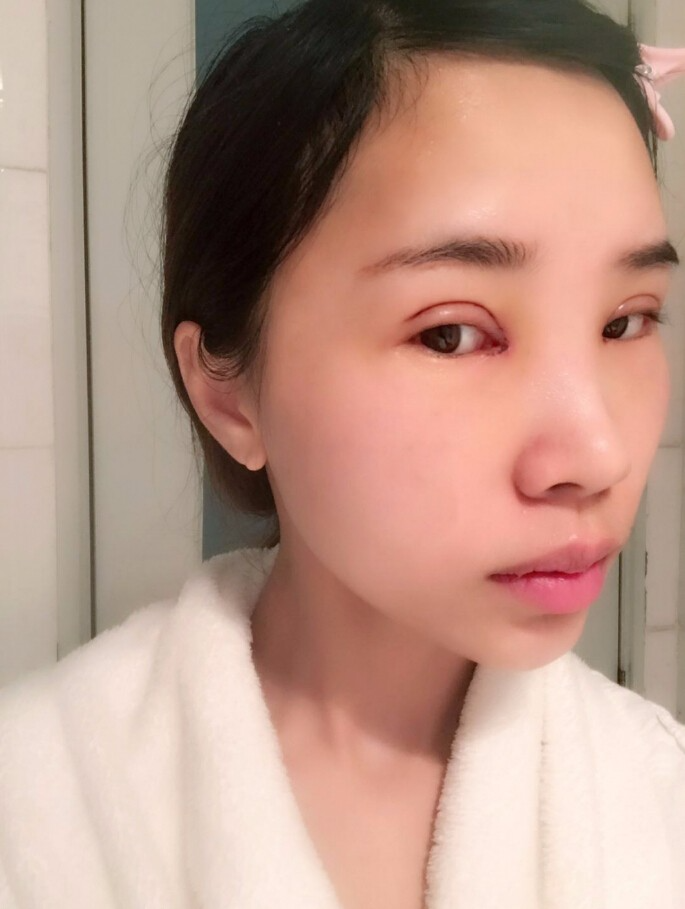 合肥艾雅整形美容醫(yī)院醫(yī)生楊海平做雙眼皮手術(shù)怎么樣？楊海平雙眼皮手術(shù)案例