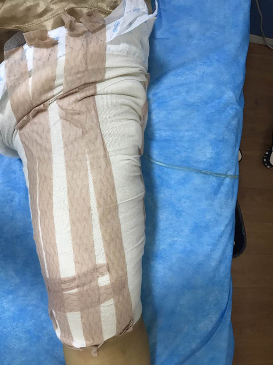 廣州軍頤醫(yī)院整形美容中心石建薇醫(yī)生腰腹吸脂真實(shí)案例對(duì)比圖