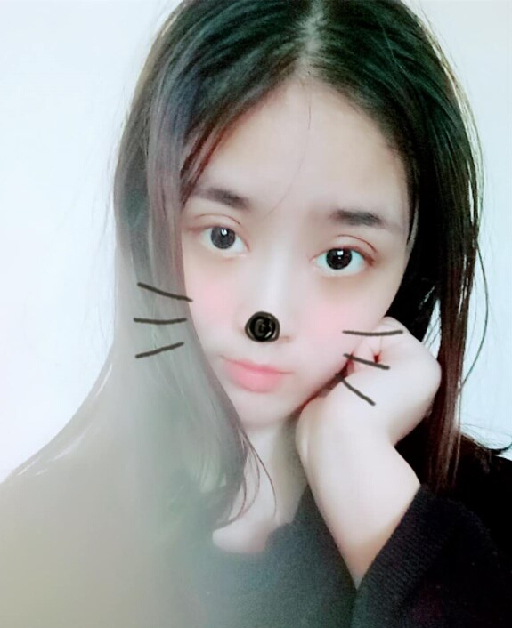 福州愛美爾整形黃林勝雙眼皮案例效果對比圖
