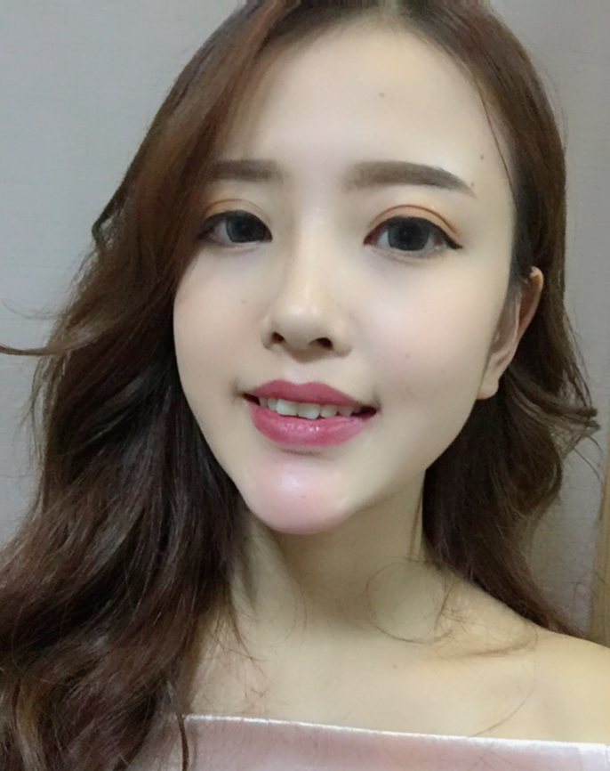 成都漢密爾頓美容醫(yī)院做牙齒矯正怎么樣？成都漢密爾頓牙齒矯正案例