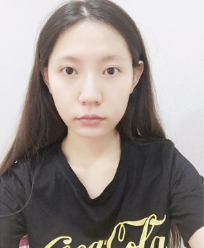  濟(jì)南安美醫(yī)療整形醫(yī)生李思思做下頜角整形怎么樣？李思思下頜角整形案例