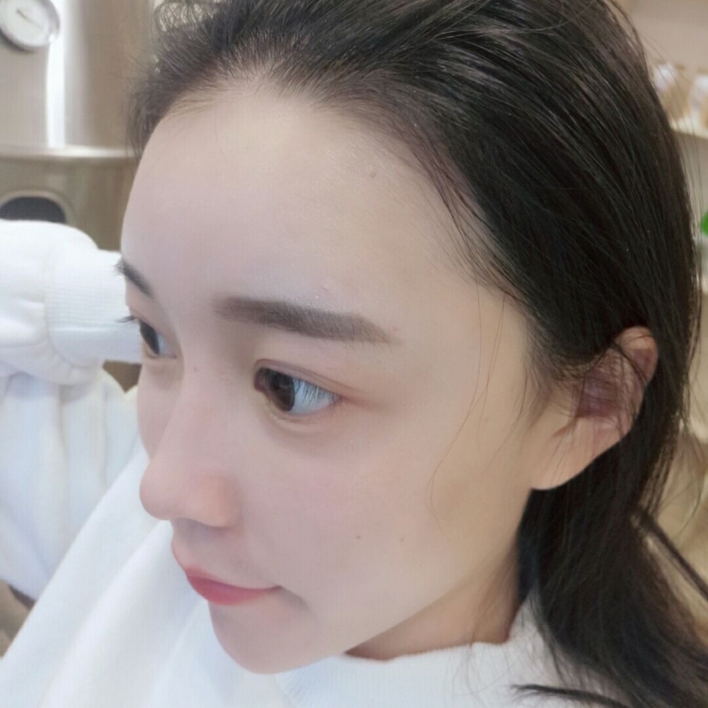 山西伊特雅整形醫(yī)生王鳳芹自體脂肪豐面頰+V-LINE瓜子臉手術(shù)案例效果圖